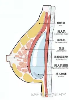 （李春财）科普：假体隆胸双平面技术更好吗？