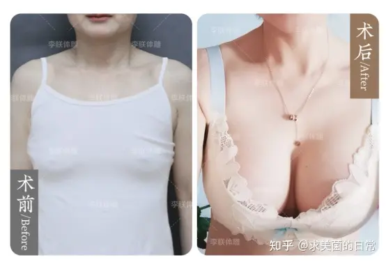 （李春财）科普：假体隆胸双平面技术更好吗？