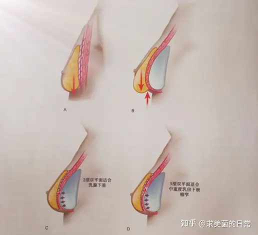 （李春财）科普：假体隆胸双平面技术更好吗？