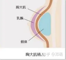 什么方法可以安全有效丰胸？