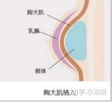 什么方法可以安全有效丰胸？