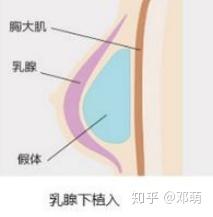 什么方法可以安全有效丰胸？