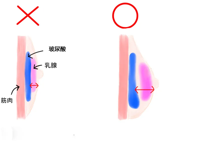 资深整容的经验之谈—丰胸