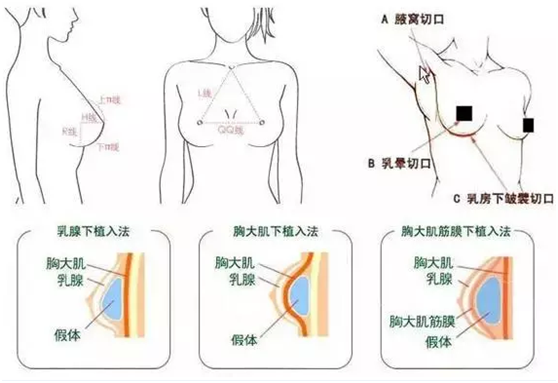 关于隆胸你不得不知的几个问题