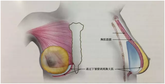 关于隆胸你不得不知的几个问题