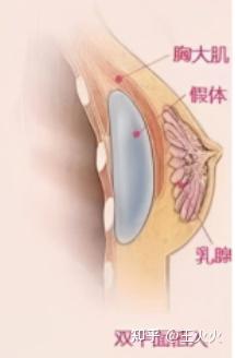 【不建议普通人碰隆胸】假体隆胸避坑指南！假体隆胸怎么做成功率最高？附全国优质隆胸医生名单