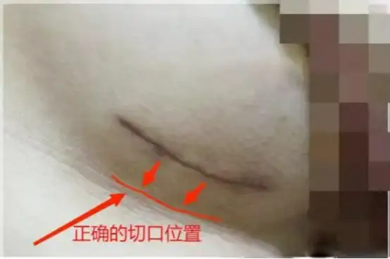 隆胸是一种什么体验?