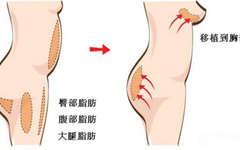 2万的假体隆胸和10万的假体隆胸区别在哪儿？多出的费用是智商税？假体隆胸想要效果好、后遗症出现概率低应该如何把控？手术切入口、假体形状材质、医生操作细节等六个要点一定要注意！