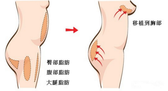 2万的假体隆胸和10万的假体隆胸区别在哪儿？多出的费用是智商税？假体隆胸想要效果好、后遗症出现概率低应该如何把控？手术切入口、假体形状材质、医生操作细节等六个要点一定要注意！