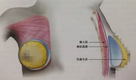 2万的假体隆胸和10万的假体隆胸区别在哪儿？多出的费用是智商税？假体隆胸想要效果好、后遗症出现概率低应该如何把控？手术切入口、假体形状材质、医生操作细节等六个要点一定要注意！