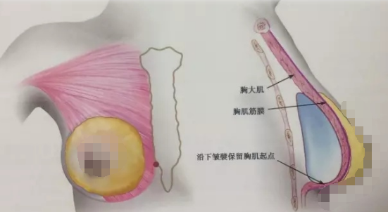 2万的假体隆胸和10万的假体隆胸区别在哪儿？多出的费用是智商税？假体隆胸想要效果好、后遗症出现概率低应该如何把控？手术切入口、假体形状材质、医生操作细节等六个要点一定要注意！