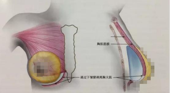 2万的假体隆胸和10万的假体隆胸区别在哪儿？多出的费用是智商税？假体隆胸想要效果好、后遗症出现概率低应该如何把控？手术切入口、假体形状材质、医生操作细节等六个要点一定要注意！